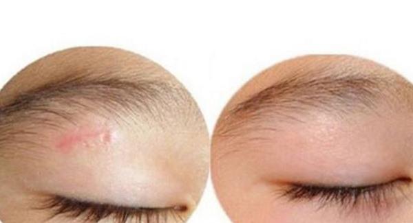 点痣留下疤痕该怎么治疗