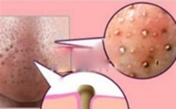 黑鼻头形成的原因