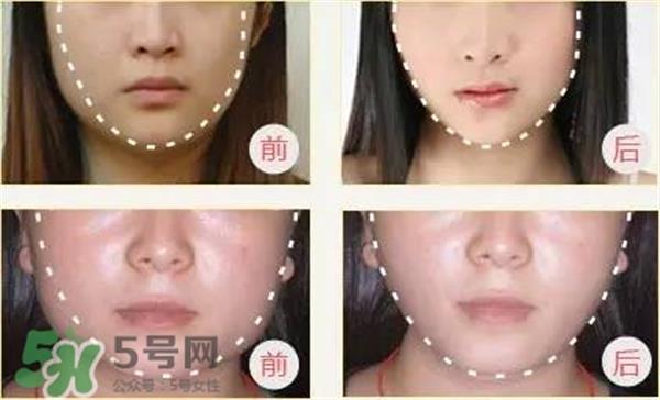 打完<a href=http://www.mx185.com/listinfo-631-0.html target=_blank class=infotextkey>瘦脸</a>针多久可以化妆？打完<a href=http://www.mx185.com/listinfo-631-0.html target=_blank class=infotextkey>瘦脸</a>针的反应