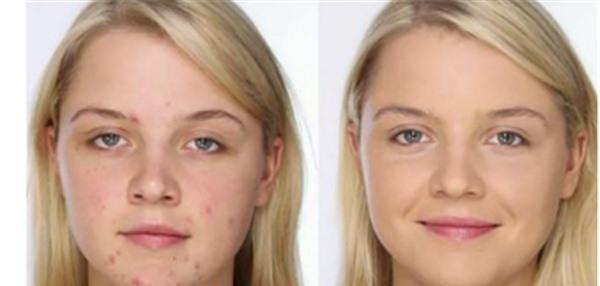 做果酸换肤袪痘疤不适应人群有哪些