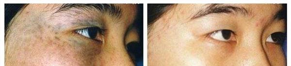 做皮肤磨削治太田痣风险有哪些