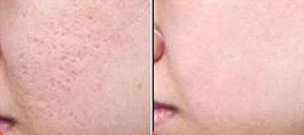 做切除缝合治疗痘疤风险有哪些