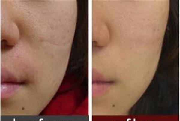 做<a href=http://www.mx185.com/listinfo-797-0.html target=_blank class=infotextkey>去痘疤</a>失败修复风险有哪些