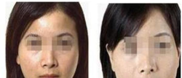 做自体脂肪<a href=http://www.mx185.com/listinfo-797-0.html target=_blank class=infotextkey>去痘疤</a>价格多少钱