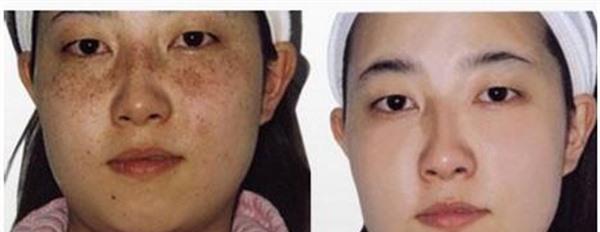 做彩光<a href=http://www.mx185.com/listinfo-795-0.html target=_blank class=infotextkey>祛斑</a>价格贵不贵