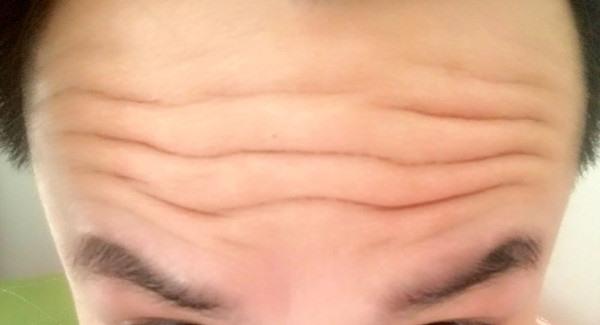 做激光去除抬头纹手术注意事项是什么？