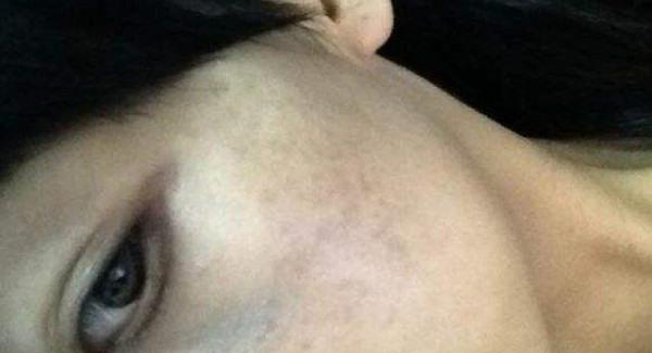 做剥脱治疗<a href=http://www.mx185.com/listinfo-774-0.html target=_blank class=infotextkey>去雀斑</a>手术注意事项是什么?