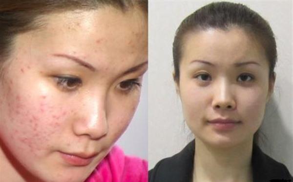 做激光祛痘多少钱