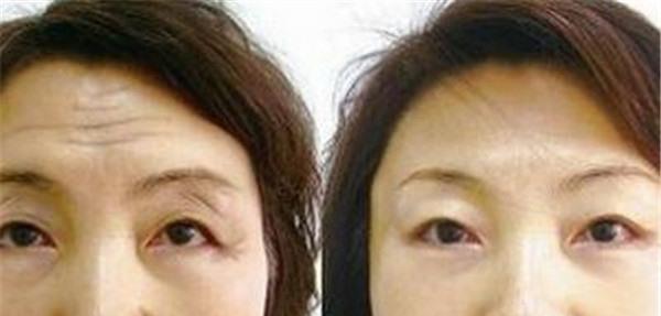 激光去除抬头纹优点是什么？