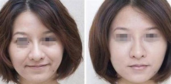 自体脂肪<a href=http://www.mx185.com/listinfo-792-0.html target=_blank class=infotextkey>去法令纹</a>手术效果好不好?