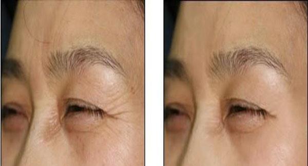 做内窥镜<a href=http://www.mx185.com/listinfo-614-0.html target=_blank class=infotextkey>除皱</a><a href=http://www.mx185.com/listinfo-780-0.html target=_blank class=infotextkey>去鱼尾纹</a>价格贵吗