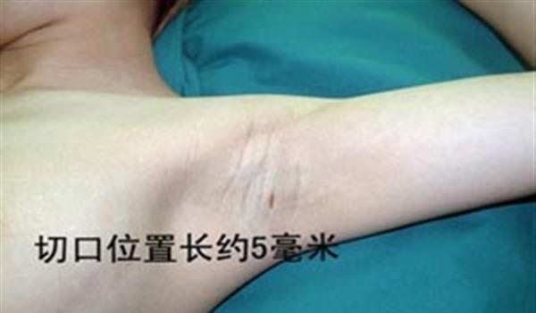 电离子<a href=http://www.mx185.com/listinfo-784-0.html target=_blank class=infotextkey>去狐臭</a>手术术后护理？