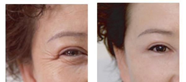 果酸换肤<a href=http://www.mx185.com/listinfo-782-0.html target=_blank class=infotextkey>去眼角细纹</a>多少钱？