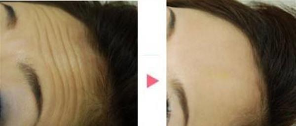 内窥镜<a href=http://www.mx185.com/listinfo-614-0.html target=_blank class=infotextkey>除皱</a><a href=http://www.mx185.com/listinfo-765-0.html target=_blank class=infotextkey>去抬头纹</a>手术安全吗?