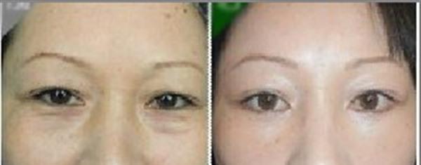 激光<a href=http://www.mx185.com/listinfo-782-0.html target=_blank class=infotextkey>去眼角细纹</a>手术术后护理?