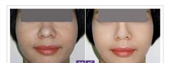 激光美白治疗方式是什么？