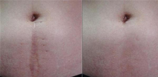 做手术疤痕修复价格