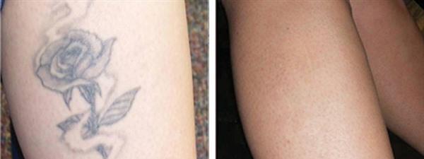 激光<a href=http://www.mx185.com/listinfo-793-0.html target=_blank class=infotextkey>洗纹身</a>手术安全吗?