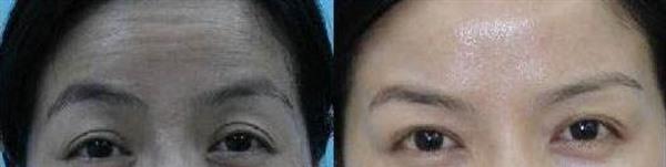 <a href=http://www.mx185.com/listinfo-734-0.html target=_blank class=infotextkey>爱贝芙</a>去除抬头纹手术缺点有哪些?