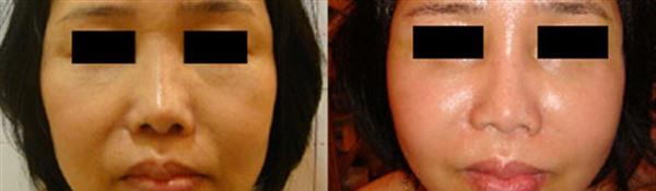 <a href=http://www.mx185.com/listinfo-792-0.html target=_blank class=infotextkey>去法令纹</a>失败修复手术术后护理?