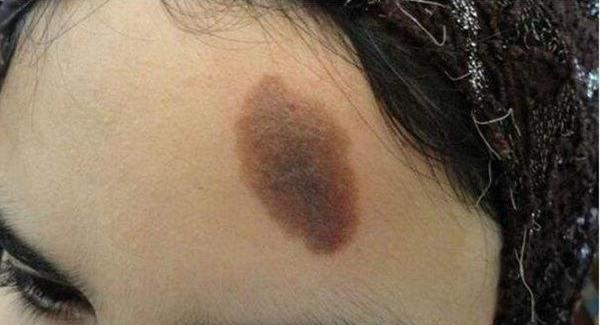 做E光<a href=http://www.mx185.com/listinfo-788-0.html target=_blank class=infotextkey>去黑痣</a>手术注意事项是什么？