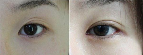 眼睑疤痕修复属于哪种类型