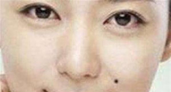 痣相去除多少钱