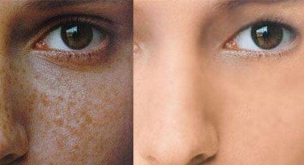 做微晶削磨<a href=http://www.mx185.com/listinfo-795-0.html target=_blank class=infotextkey>祛斑</a>手术注意事项是什么？