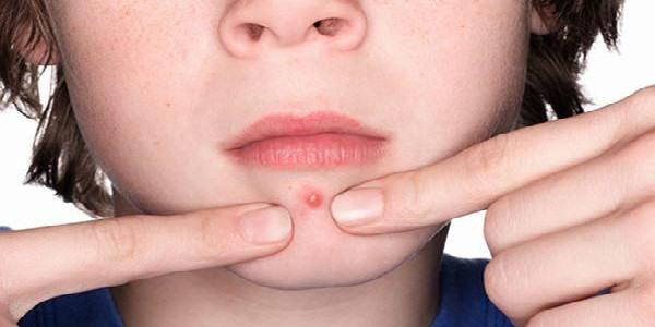 激光<a href=http://www.mx185.com/listinfo-779-0.html target=_blank class=infotextkey>治疗痤疮</a>疼吗