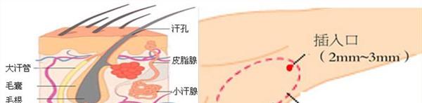 电离子<a href=http://www.mx185.com/listinfo-766-0.html target=_blank class=infotextkey>去腋臭</a>麻醉方式是什么？
