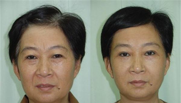 做E光<a href=http://www.mx185.com/listinfo-792-0.html target=_blank class=infotextkey>去法令纹</a>价格