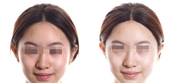 红蓝光美肤适合什么人？