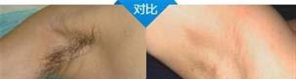 做冷冻<a href=http://www.mx185.com/listinfo-784-0.html target=_blank class=infotextkey>去狐臭</a>多少钱