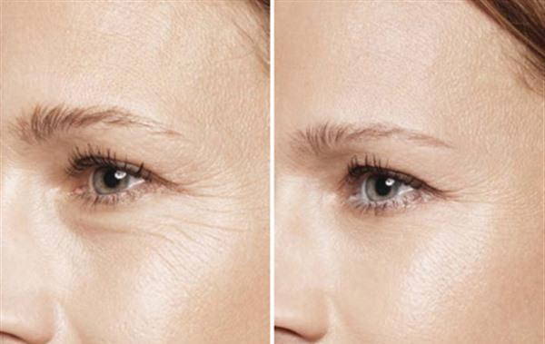 做额颞部<a href=http://www.mx185.com/listinfo-614-0.html target=_blank class=infotextkey>除皱</a><a href=http://www.mx185.com/listinfo-780-0.html target=_blank class=infotextkey>去鱼尾纹</a>价格是多少