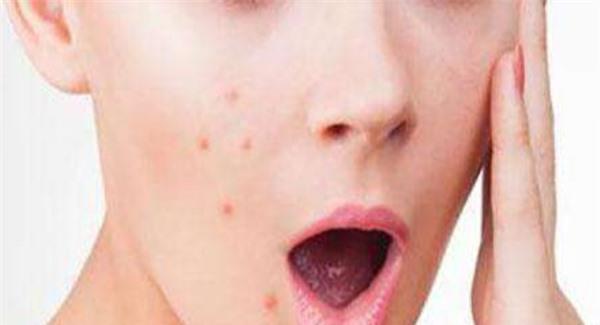 祛痘多少钱一次