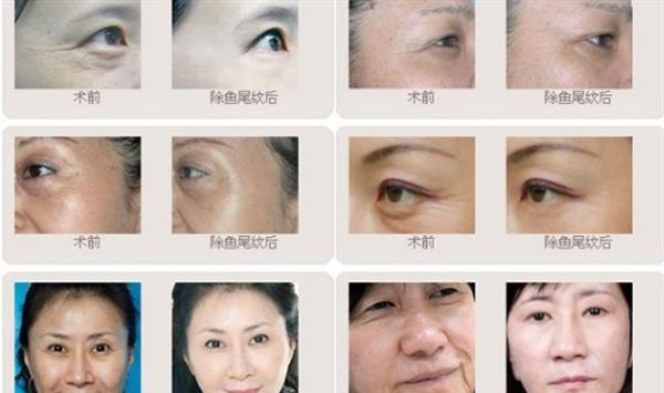 做内窥镜<a href=http://www.mx185.com/listinfo-614-0.html target=_blank class=infotextkey>除皱</a><a href=http://www.mx185.com/listinfo-780-0.html target=_blank class=infotextkey>去鱼尾纹</a>治疗效果怎么样？效果保持时间多久？