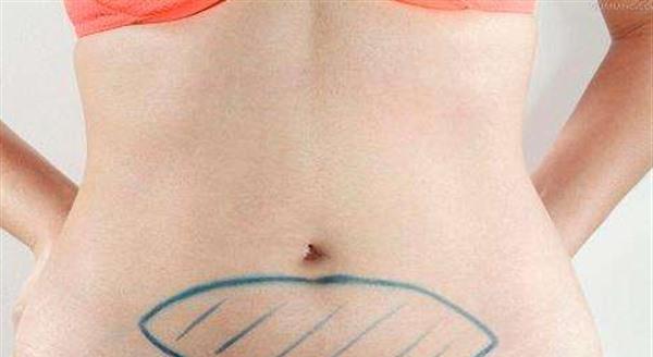 怎么消除妊娠纹