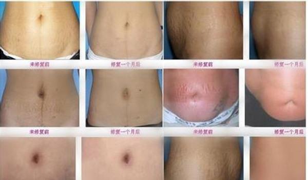 剖腹产疤痕修复多久能恢复？