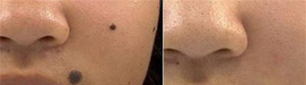 化学剥脱点痣手术的方法是什么?