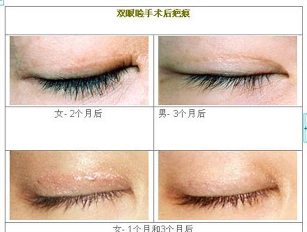 做眼睑疤痕修复价格是多少