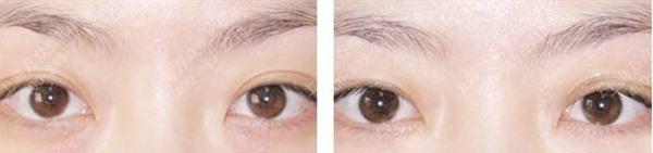 激光<a href=http://www.mx185.com/listinfo-782-0.html target=_blank class=infotextkey>去眼角细纹</a>手术安全吗?