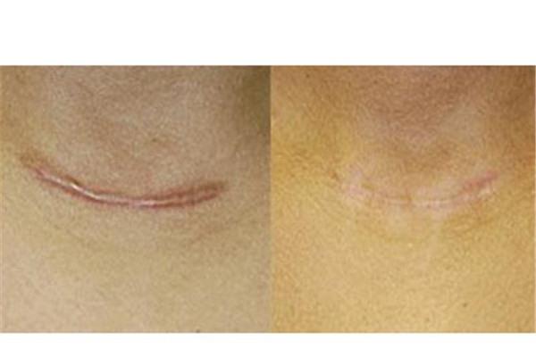 做注射去疤价格