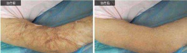 做烫伤疤痕修复价格要多少