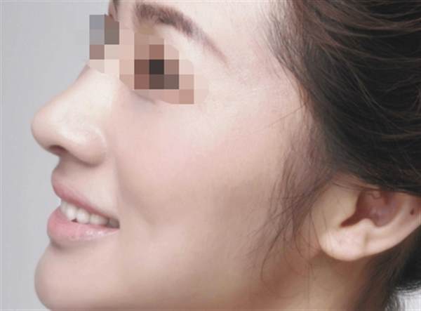 自体脂肪<a href=http://www.mx185.com/listinfo-737-0.html target=_blank class=infotextkey>隆鼻</a>恢复期多久
