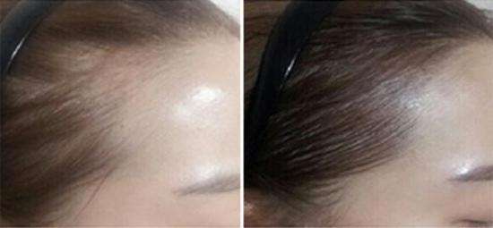发际线过高或过低要如何改善