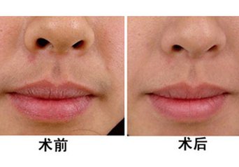 激光<a href=http://www.mx185.com/listinfo-665-0.html target=_blank class=infotextkey>脱唇毛</a>会复发吗