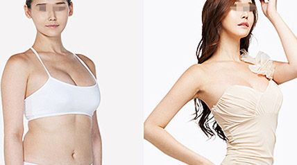 <a href=http://www.mx185.com/listinfo-617-0.html target=_blank class=infotextkey>巨乳缩小</a>手术方式，术后恢复过程