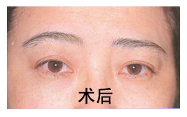 做完重睑术后如何保养
