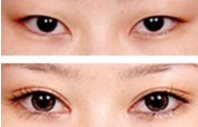 <a href=http://www.mx185.com/listinfo-724-0.html target=_blank class=infotextkey>双眼皮</a>贴一定会松弛吗