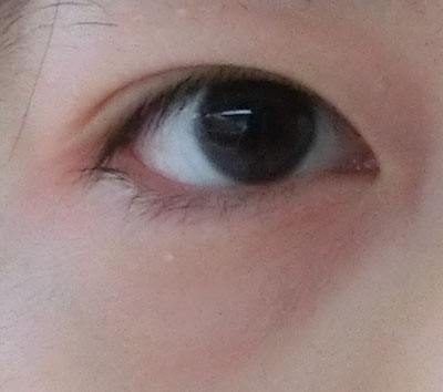 眼部抽脂眼皮会松吗